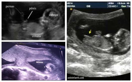 sexo do bebê ultrassom