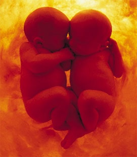 Gravidez de gêmeos no útero