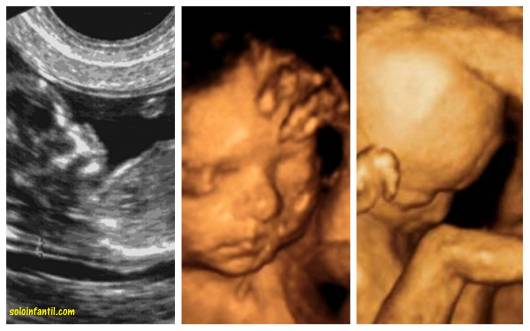 diferenças ultrassonografias