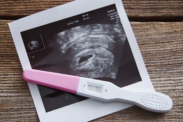 foto de teste com ultrassom para anunciar gravidez